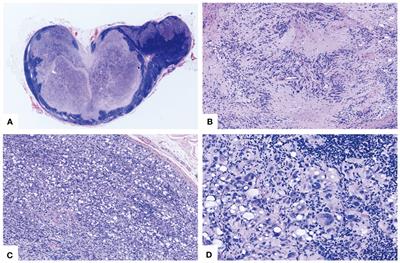 Primary lipoblastic nerve sheath tumor in an inguinal lymph node mimicking metastatic tumor: a case report and literature review